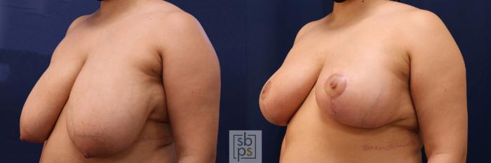 Before & After Breast Reduction Case 561 Right Oblique View in Torrance, CA