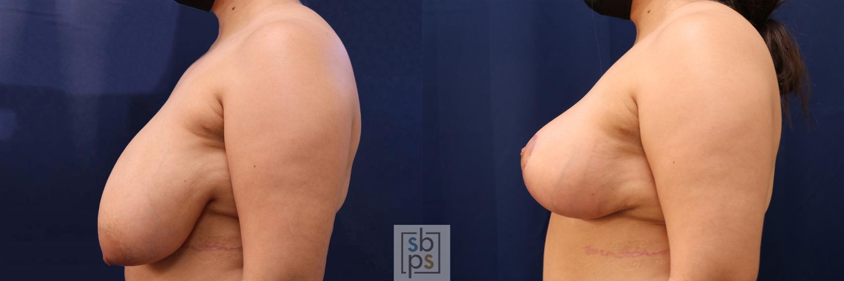 Before & After Breast Reduction Case 561 Right Side View in Torrance & Los Angeles, CA, CA