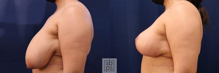 Before & After Breast Reduction Case 561 Right Side View in Torrance, CA