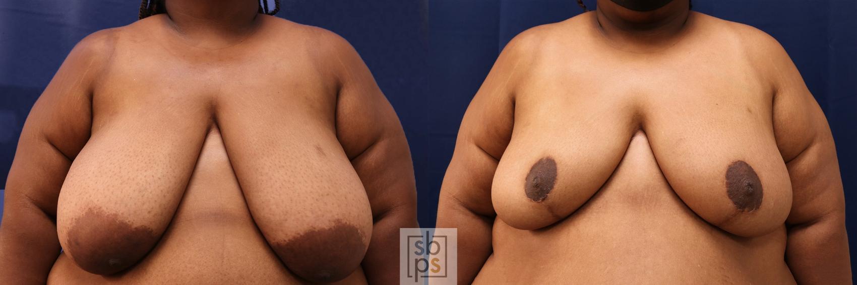 Before & After Breast Reduction Case 568 Front View in Torrance, CA