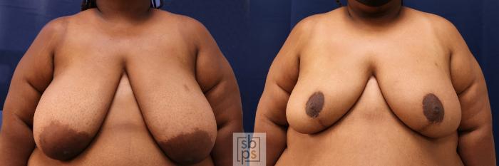 Before & After Breast Reduction Case 568 Front View in Los Angeles & Torrance, CA, CA