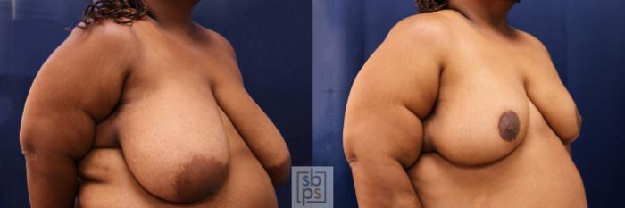 Before & After Breast Reduction Case 568 Left Oblique View in Los Angeles & Torrance, CA, CA