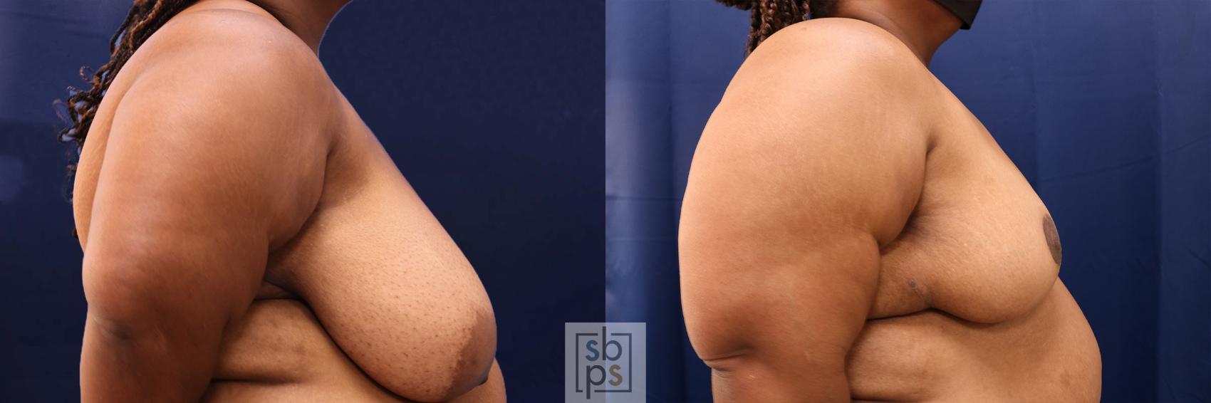Before & After Breast Reduction Case 568 Left Side View in Torrance & Los Angeles, CA, CA