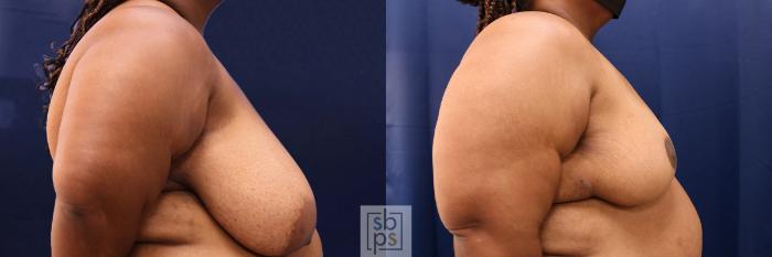 Before & After Breast Reduction Case 568 Left Side View in Los Angeles & Torrance, CA, CA