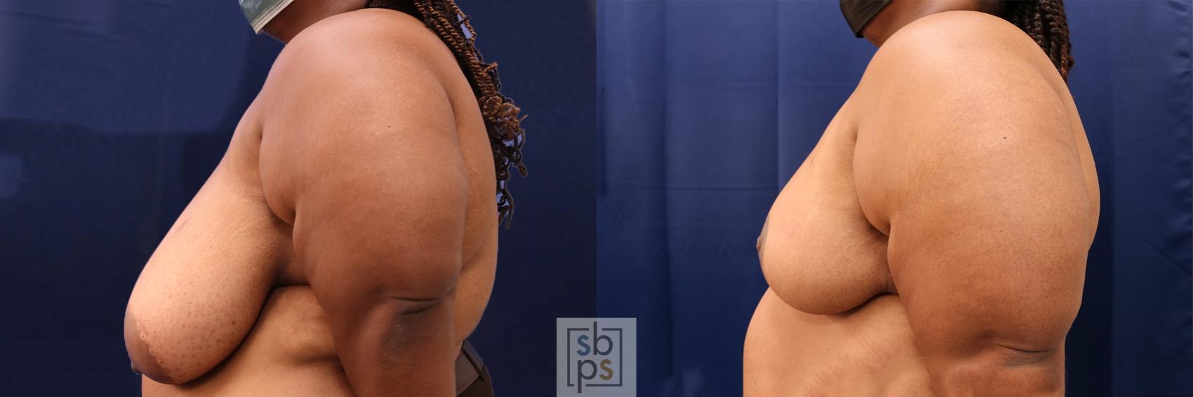 Before & After Breast Reduction Case 568 Right Side View in Torrance & Los Angeles, CA, CA