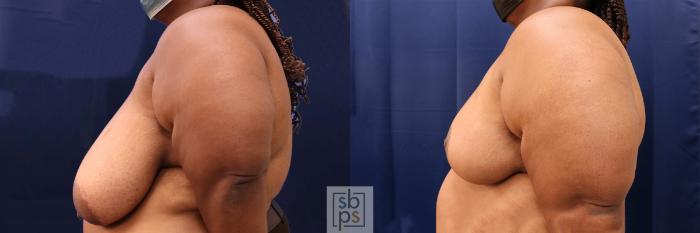 Before & After Breast Reduction Case 568 Right Side View in Los Angeles & Torrance, CA, CA