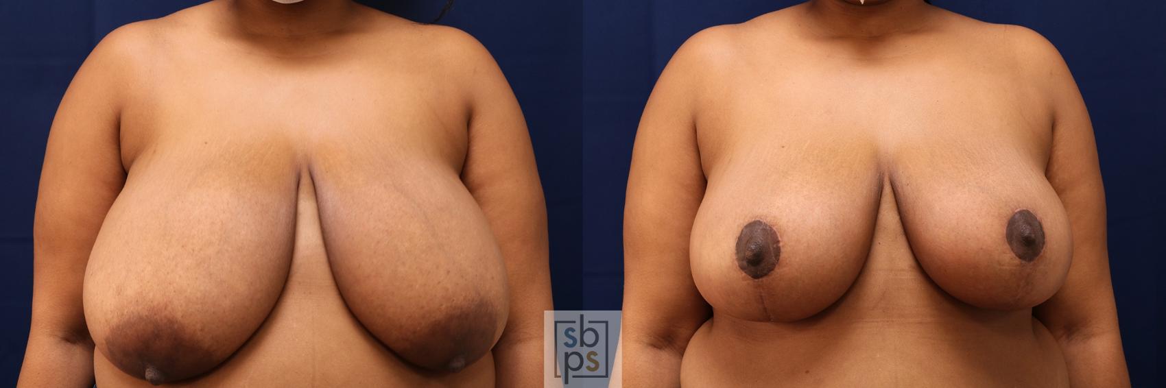 Before & After Breast Reduction Case 571 Front View in Torrance, CA