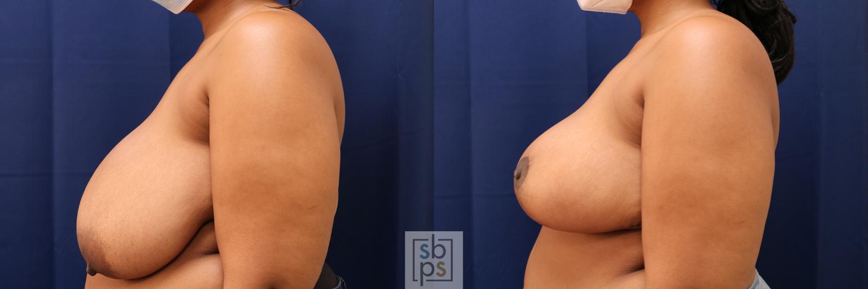 Before & After Breast Reduction Case 571 Left Side View in Torrance & Los Angeles, CA, CA