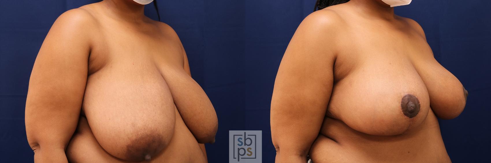 Before & After Breast Reduction Case 571 Right Oblique View in Torrance & Los Angeles, CA, CA