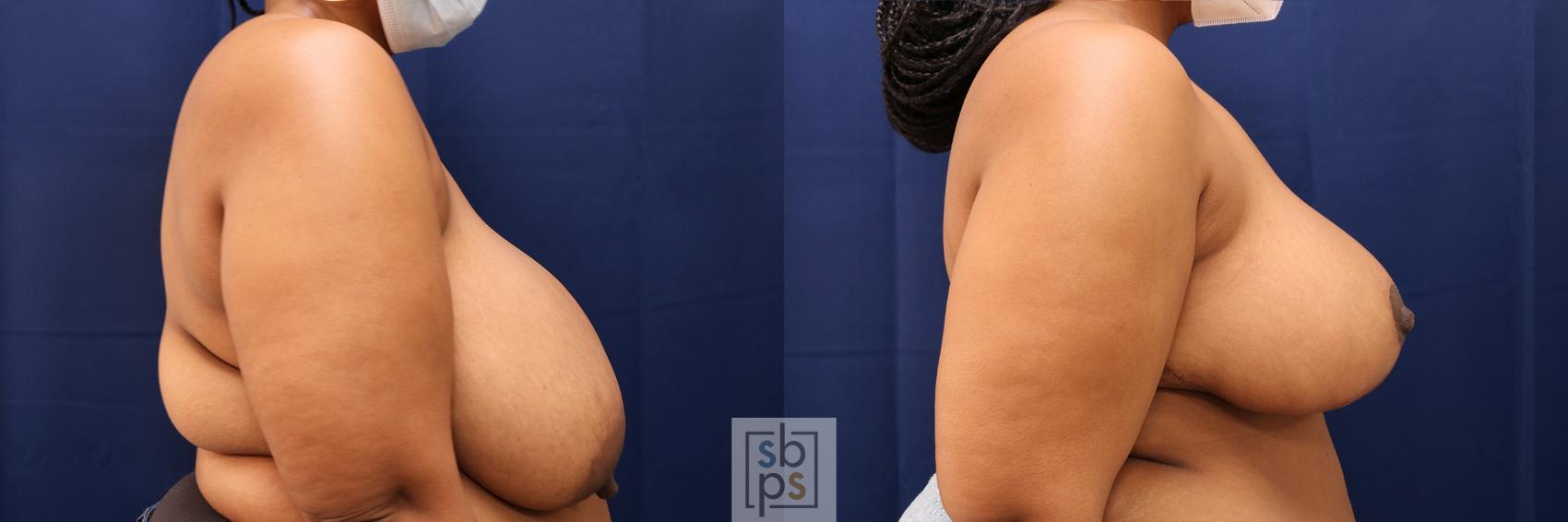 Before & After Breast Reduction Case 571 Right Side View in Torrance & Los Angeles, CA, CA