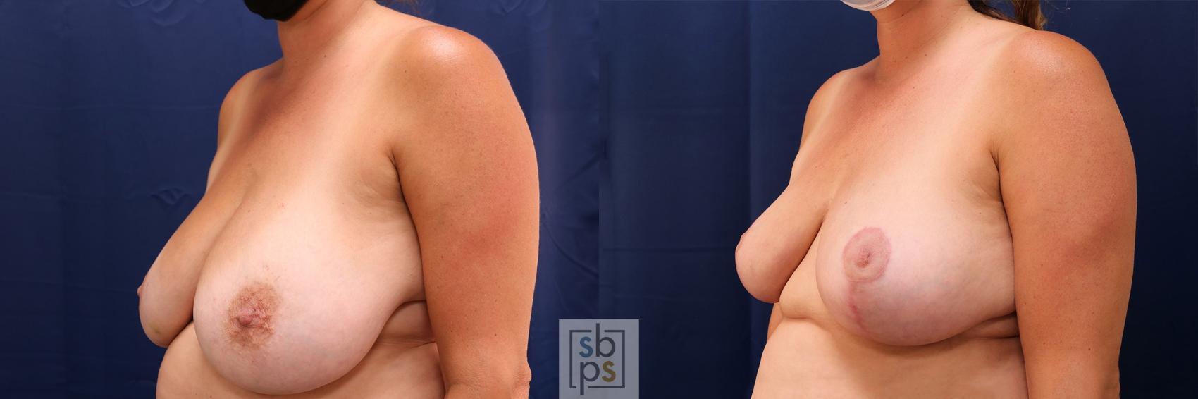 Before & After Breast Reduction Case 582 Left Oblique View in Los Angeles, Torrance & Long Beach, CA