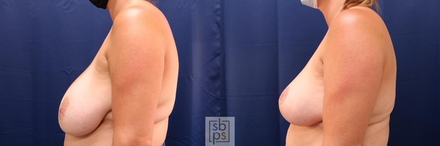 Before & After Breast Reduction Case 582 Left Side View in Los Angeles, Torrance & Long Beach, CA