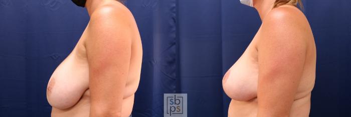 Before & After Breast Reduction Case 582 Left Side View in Torrance, CA
