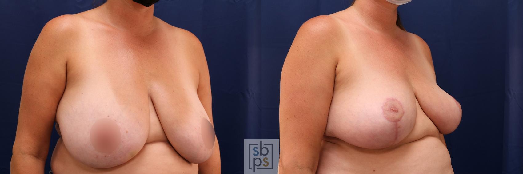 Before & After Breast Reduction Case 582 Right Oblique View in Los Angeles, Torrance & Long Beach, CA