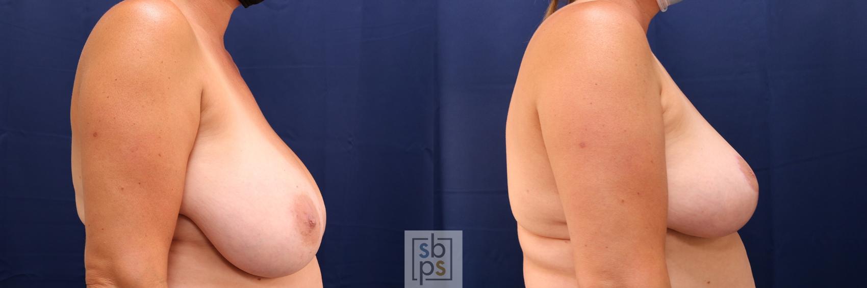 Before & After Breast Reduction Case 582 Right Side View in Los Angeles, Torrance & Long Beach, CA