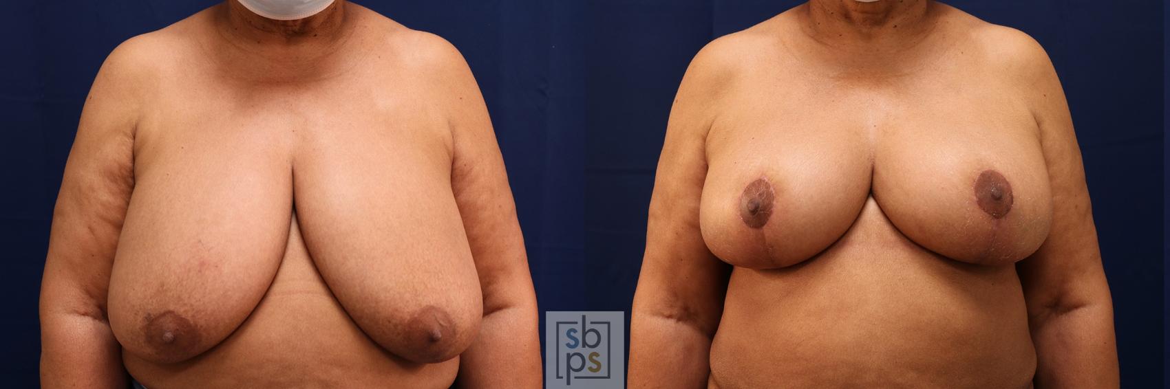 Before & After Breast Reduction Case 583 Front View in Torrance, CA