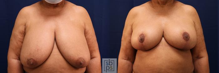 Before & After Breast Reduction Case 583 Front View in Torrance, CA