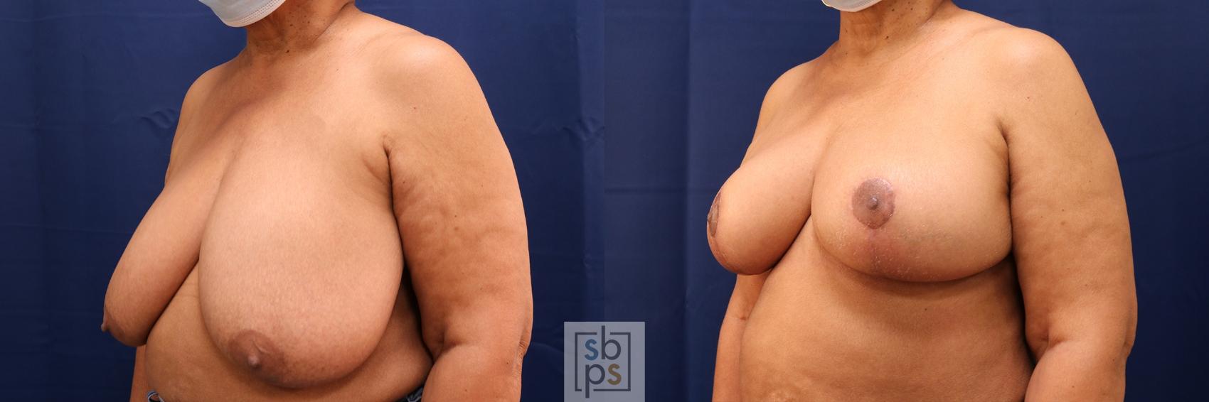 Before & After Breast Reduction Case 583 Left Oblique View in Los Angeles, Torrance & Long Beach, CA