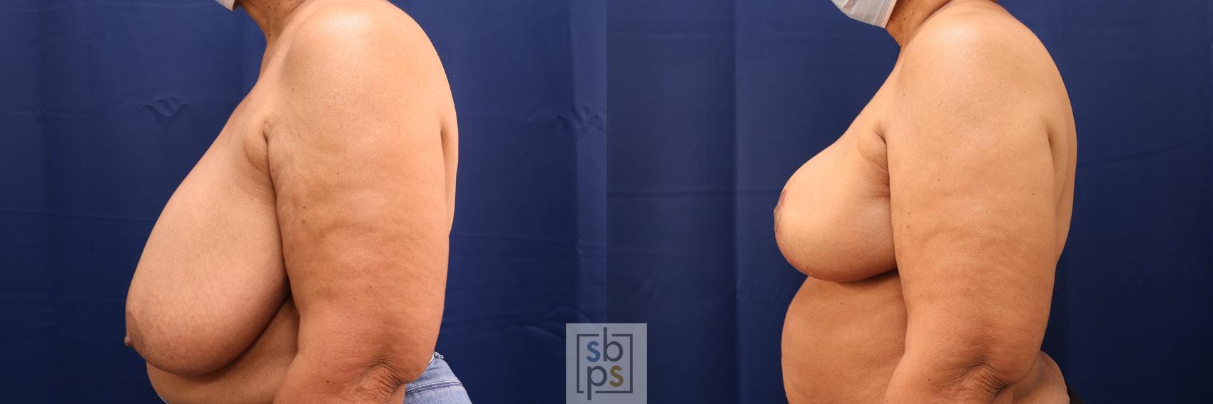 Before & After Breast Reduction Case 583 Left Side View in Los Angeles, Torrance & Long Beach, CA