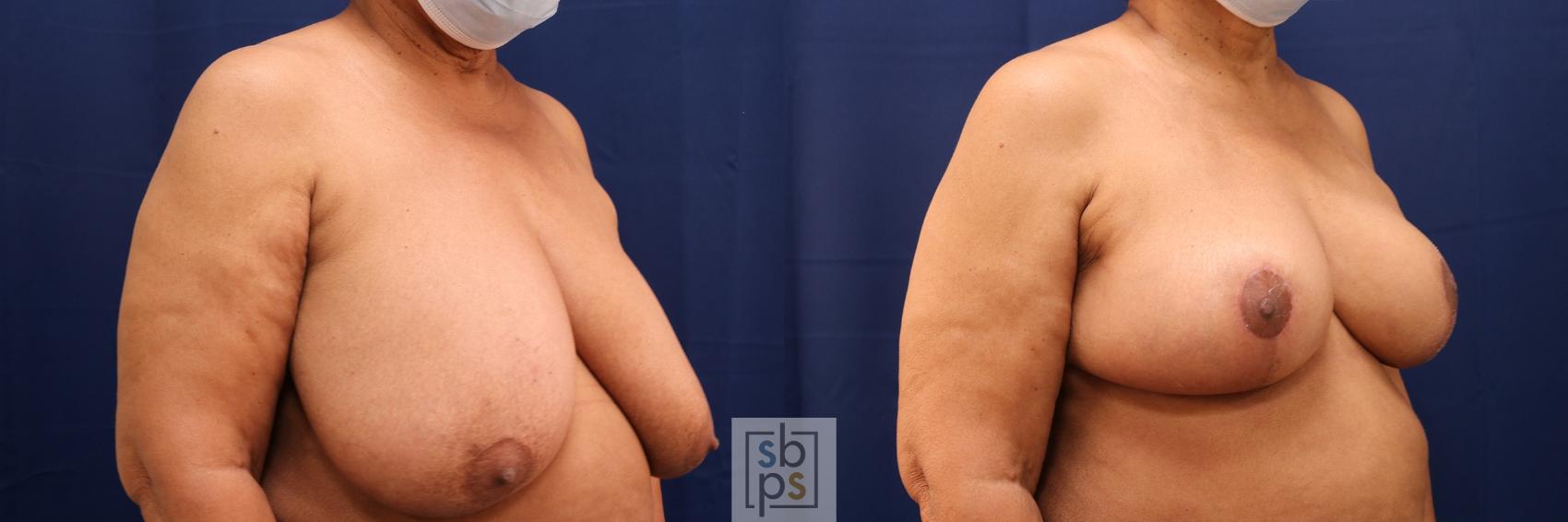 Before & After Breast Reduction Case 583 Right Oblique View in Los Angeles, Torrance & Long Beach, CA