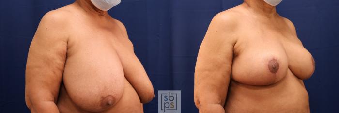 Before & After Breast Reduction Case 583 Right Oblique View in Torrance, CA