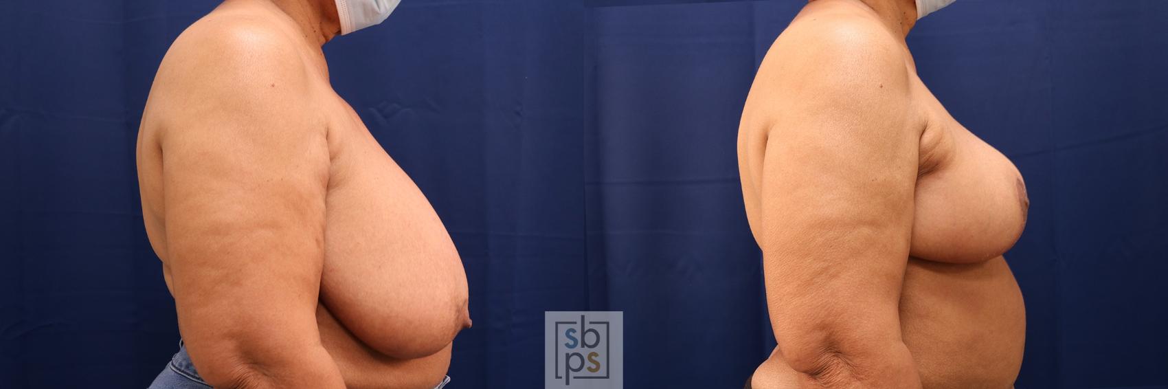 Before & After Breast Reduction Case 583 Right Side View in Los Angeles, Torrance & Long Beach, CA