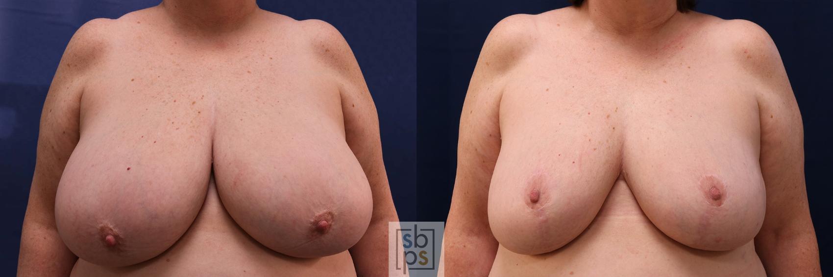 Before & After Breast Reduction Case 595 Front View in Torrance, CA