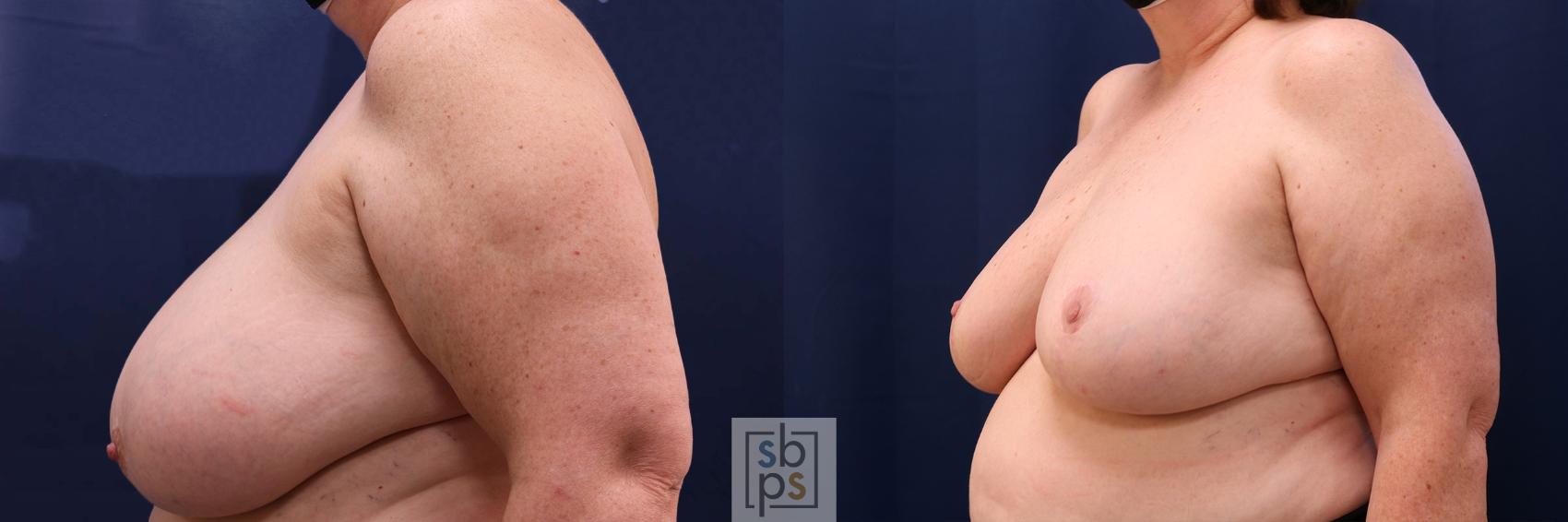 Before & After Breast Reduction Case 595 Left Oblique View in Torrance, CA
