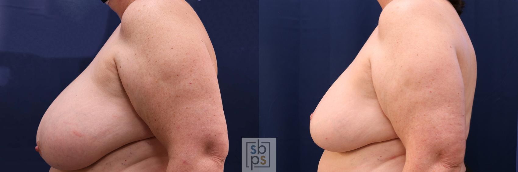 Before & After Breast Reduction Case 595 Left Side View in Torrance, CA