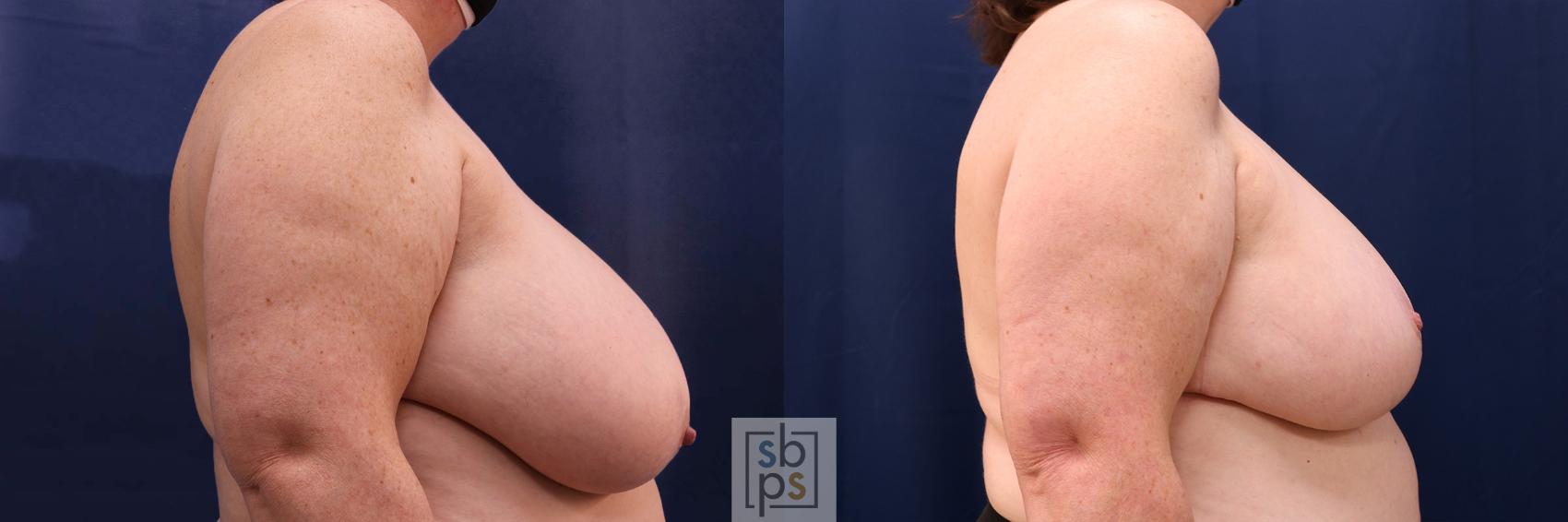 Before & After Breast Reduction Case 595 Right Side View in Torrance, CA