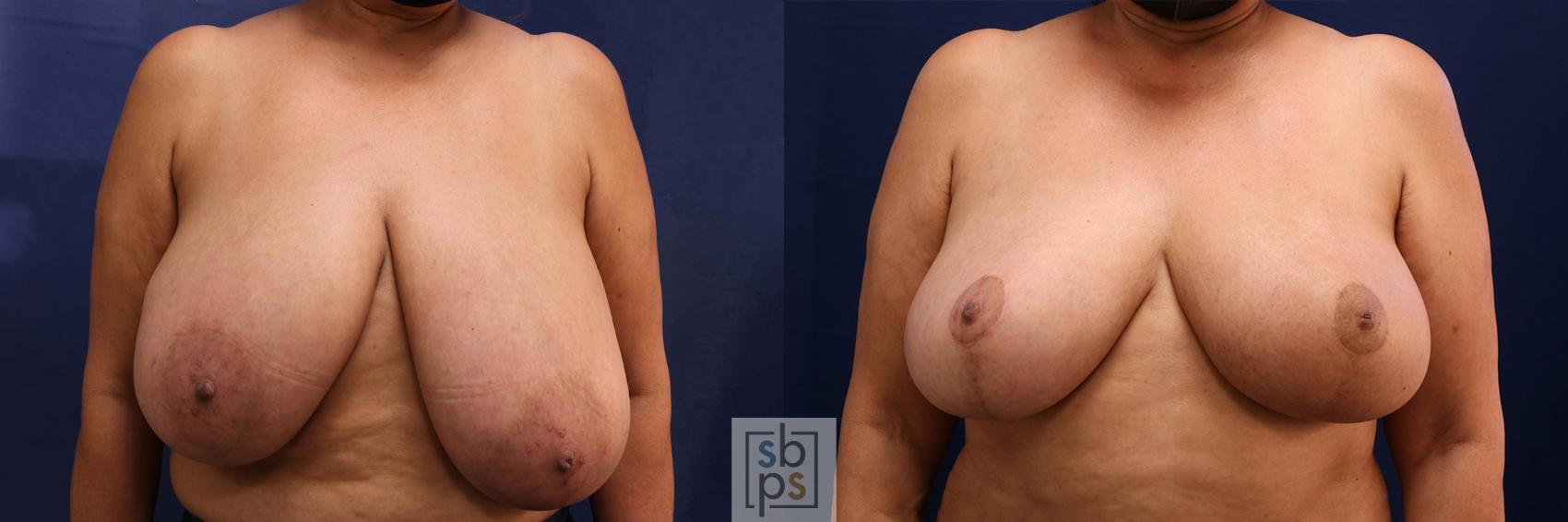 Before & After Breast Reduction Case 598 Front View in Torrance, CA