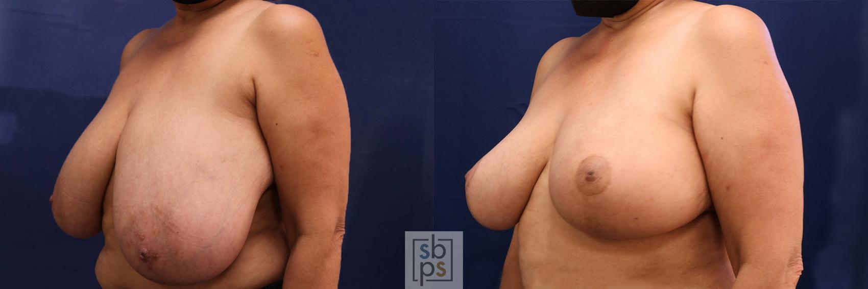 Before & After Breast Reduction Case 598 Left Oblique View in Torrance, CA