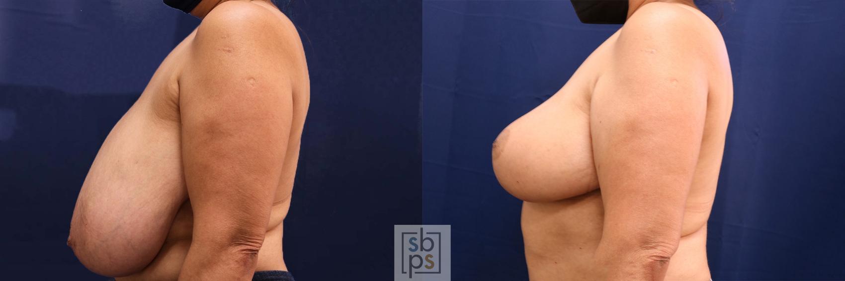 Before & After Breast Reduction Case 598 Left Side View in Torrance, CA