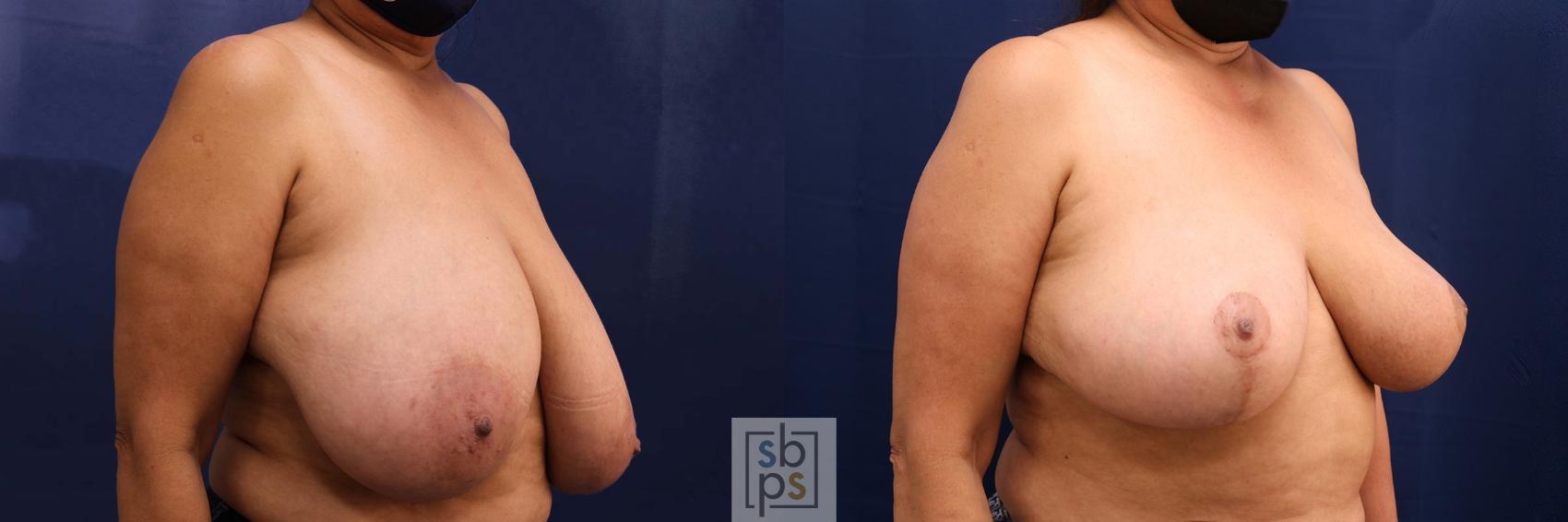 Before & After Breast Reduction Case 598 Right Oblique View in Torrance, CA