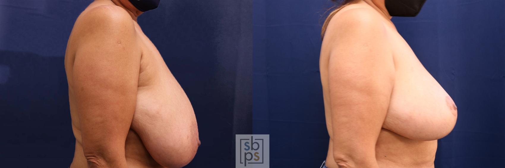 Before & After Breast Reduction Case 598 Right Side View in Torrance, CA