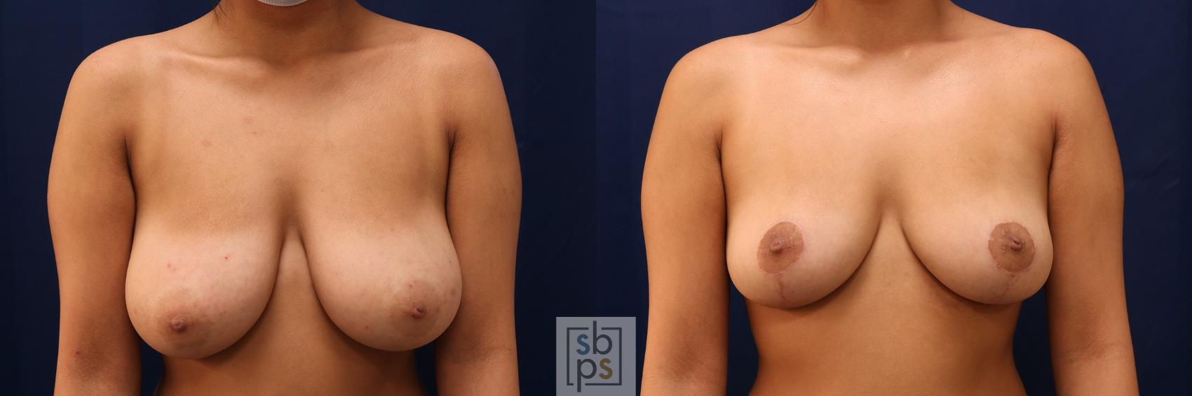 Before & After Breast Reduction Case 602 Front View in Torrance, CA