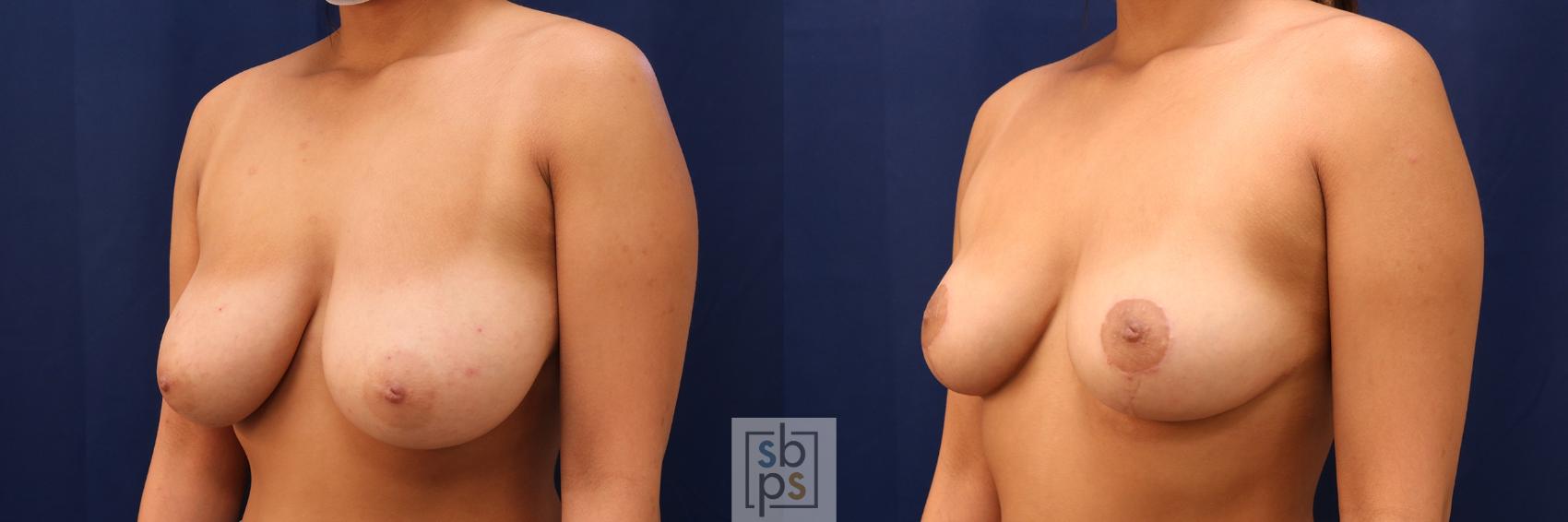 Before & After Breast Reduction Case 602 Left Oblique View in Torrance, CA