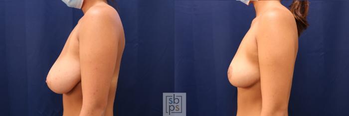 Before & After Breast Reduction Case 602 Left Side View in Torrance, CA