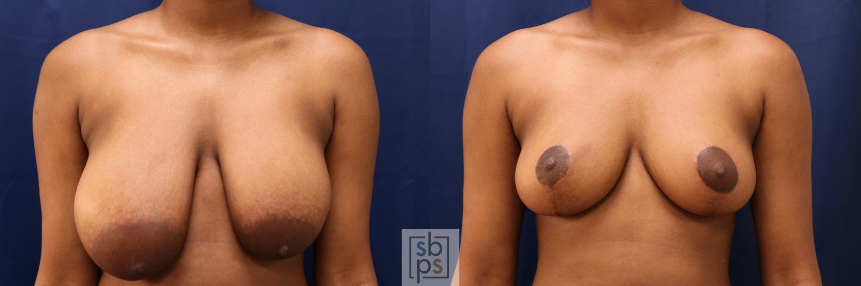 Before & After Breast Reduction Case 604 Front View in Torrance, CA