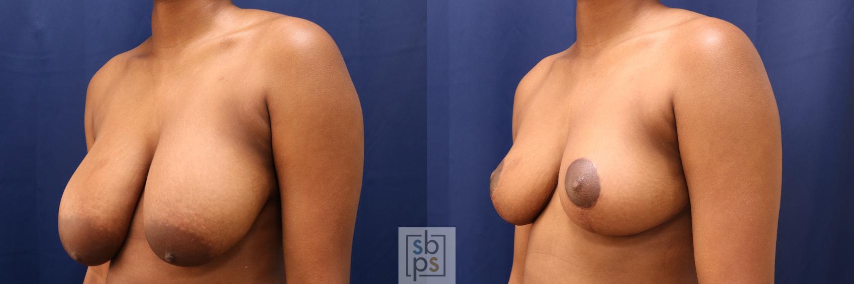 Before & After Breast Reduction Case 604 Left Oblique View in Torrance, CA
