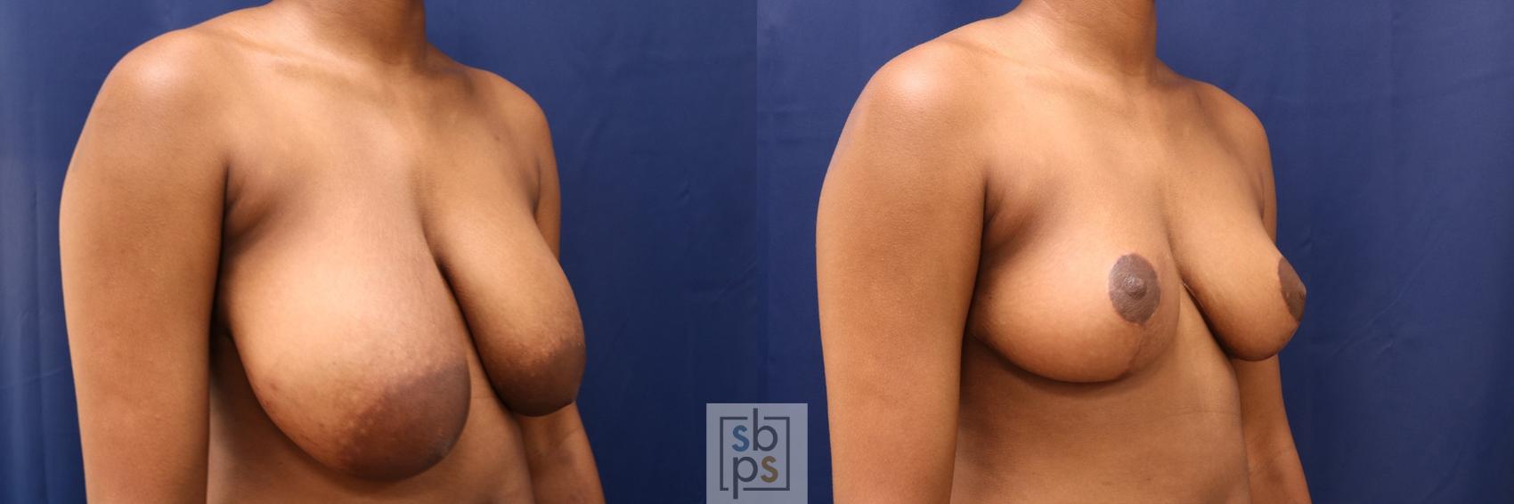 Before & After Breast Reduction Case 604 Right Oblique View in Torrance, CA