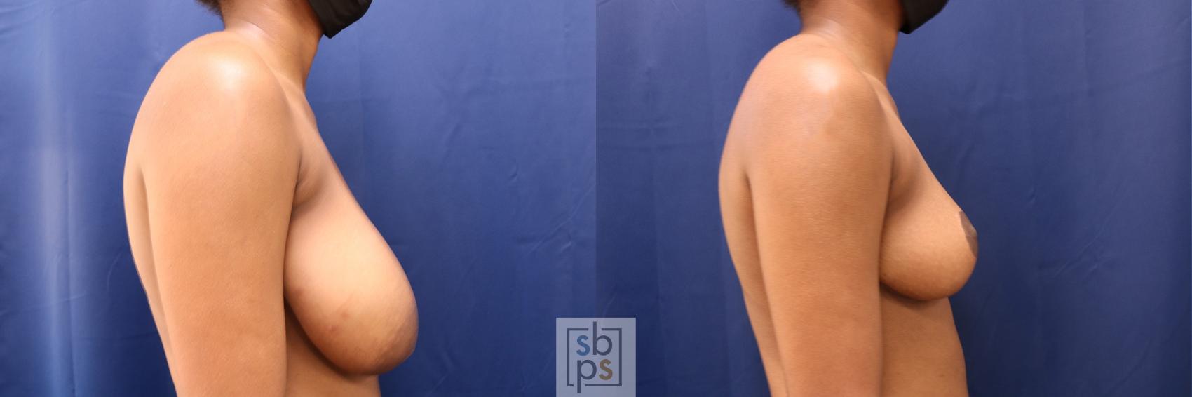 Before & After Breast Reduction Case 604 Right Side View in Torrance, CA