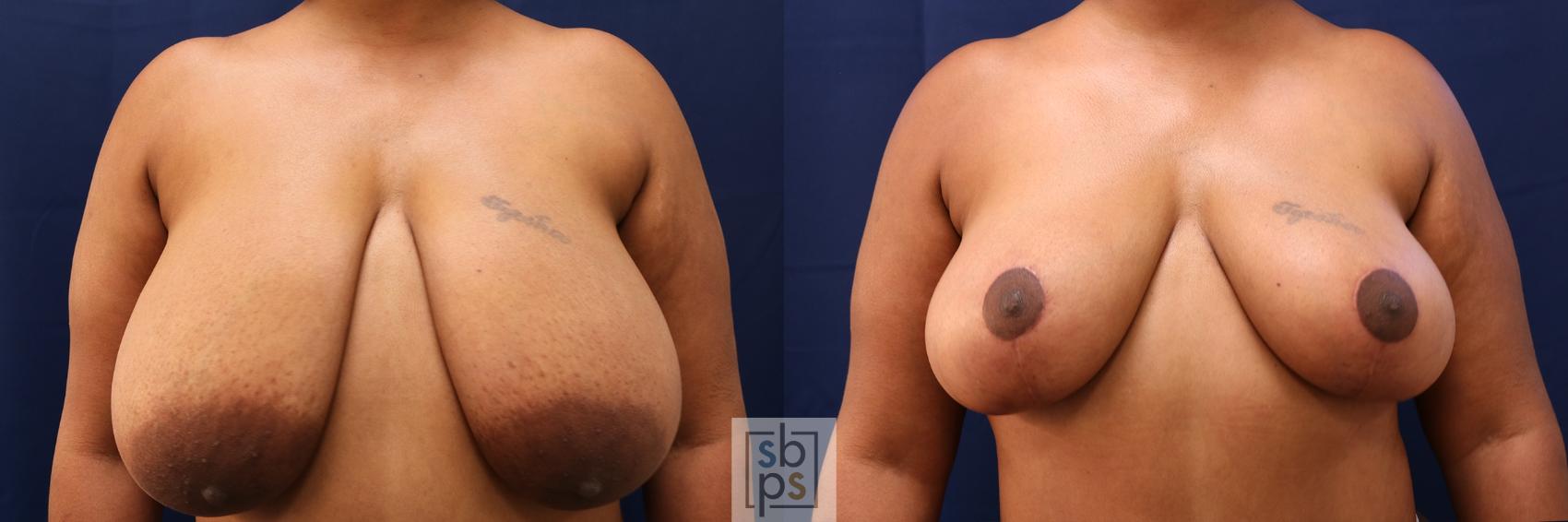 Before & After Breast Reduction Case 605 Front View in Torrance, CA