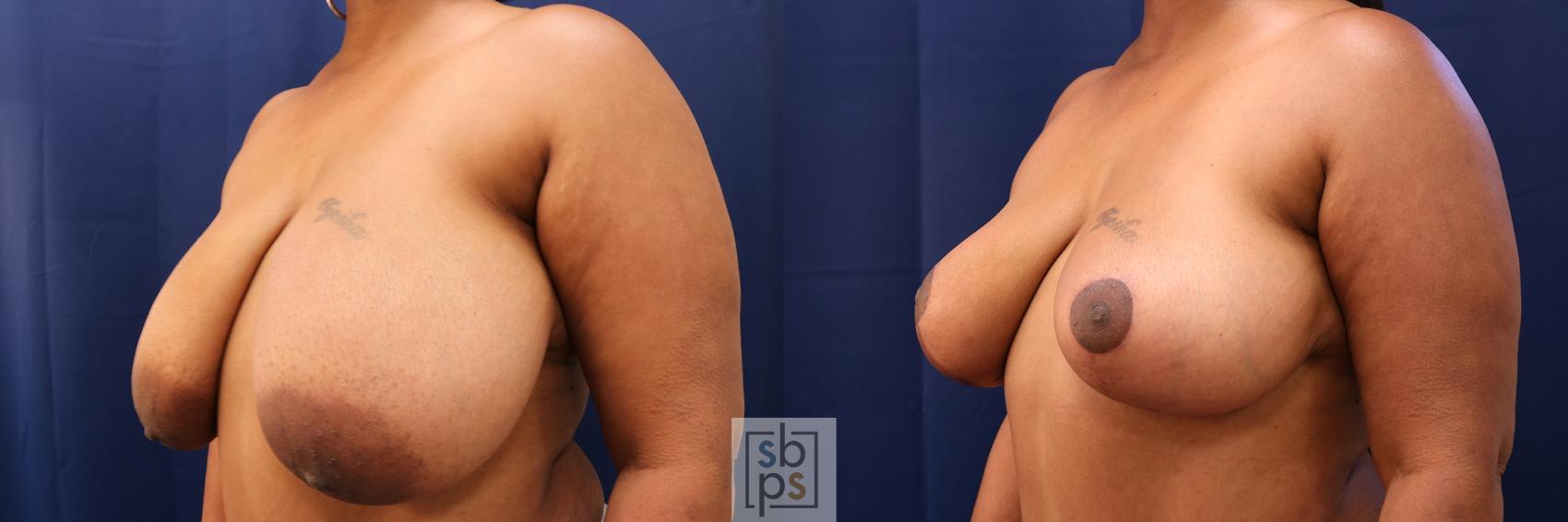 Before & After Breast Reduction Case 605 Left Oblique View in Torrance, CA