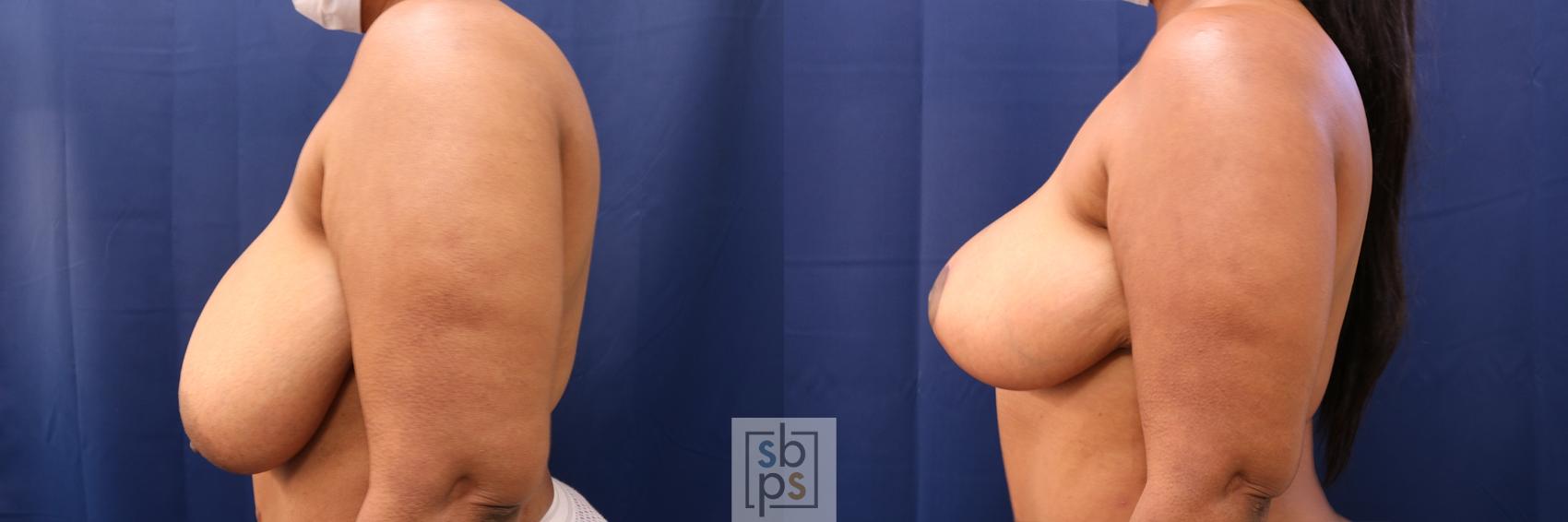 Before & After Breast Reduction Case 605 Left Side View in Torrance, CA