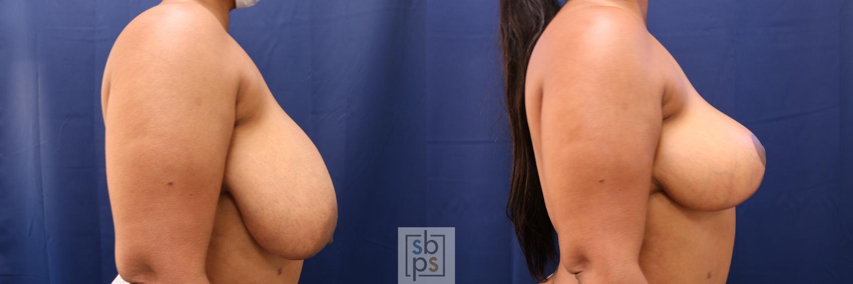 Before & After Breast Reduction Case 605 Right Side View in Torrance, CA