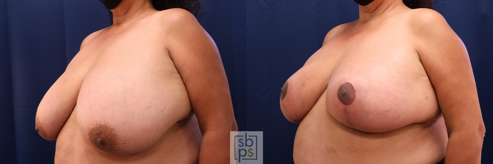 Before & After Breast Reduction Case 615 Left Oblique View in Torrance, CA