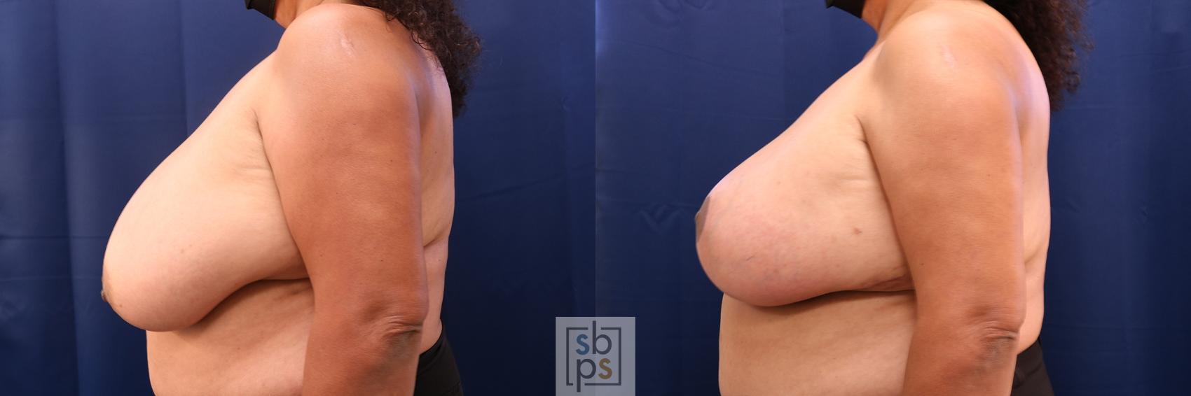 Before & After Breast Reduction Case 615 Left Side View in Torrance, CA