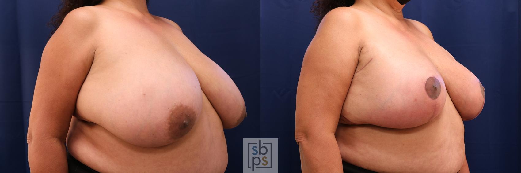 Before & After Breast Reduction Case 615 Right Oblique View in Torrance, CA