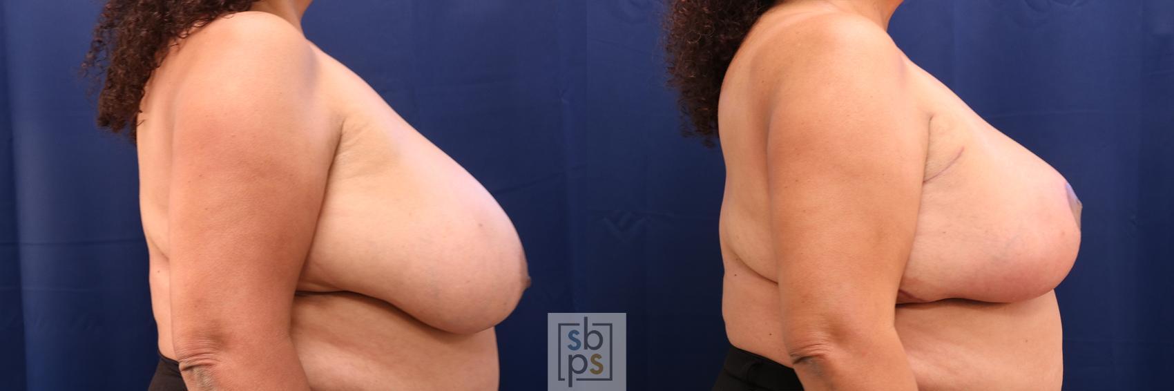 Before & After Breast Reduction Case 615 Right Side View in Torrance, CA